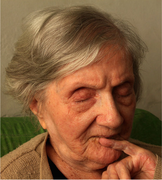 ältere Frau mit Demenz